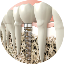 Dental Implants for permanently replacing teeth