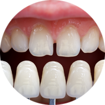 Porcelain Dental Veneers for Improving Your Smile